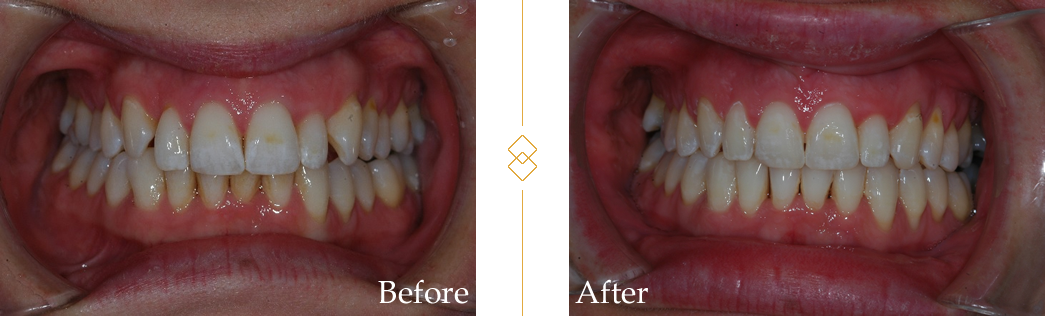 Before and After Dental Photos